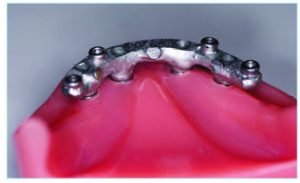 Barra Locator Siscator Croco Calcinable Cromo Cobalto Sobre Implante