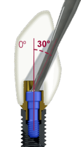 Ti Base Implante Tornillo Angulado Smart Angle