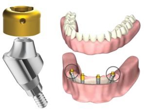 Locator Para Multi Unit Siscator